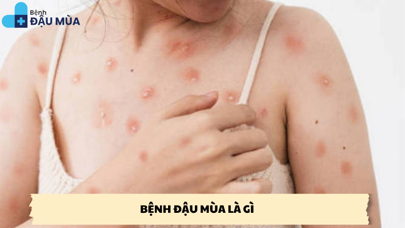 bệnh đậu mùa là gì