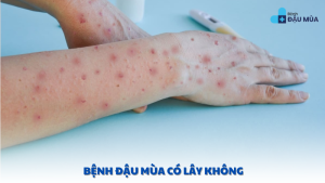 bệnh đậu mùa có lây không