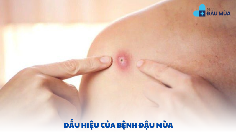 dấu hiệu của bệnh đậu mùa